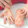 Bệnh chân tay miệng ở trẻ em nguyên nhân nào gây nên?