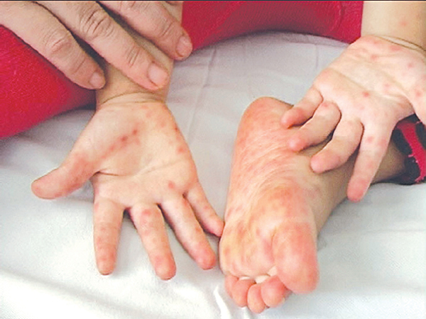Bệnh chân tay miệng ở trẻ em nguyên nhân nào gây nên?